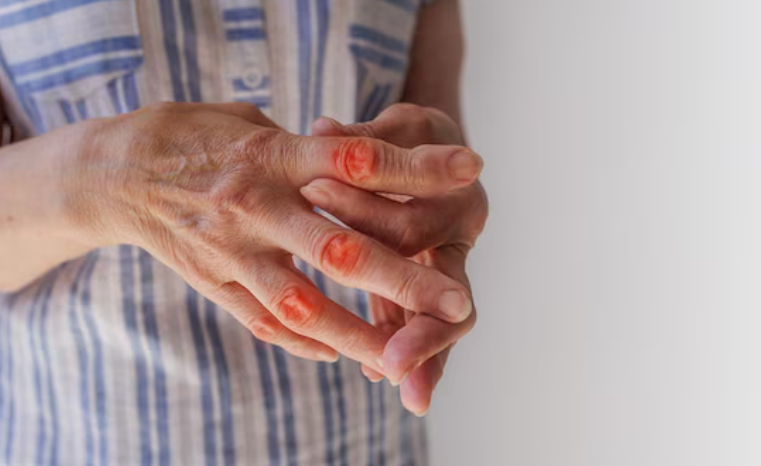 Artrite gotosa: Sinais de alerta e a importância do diagnóstico