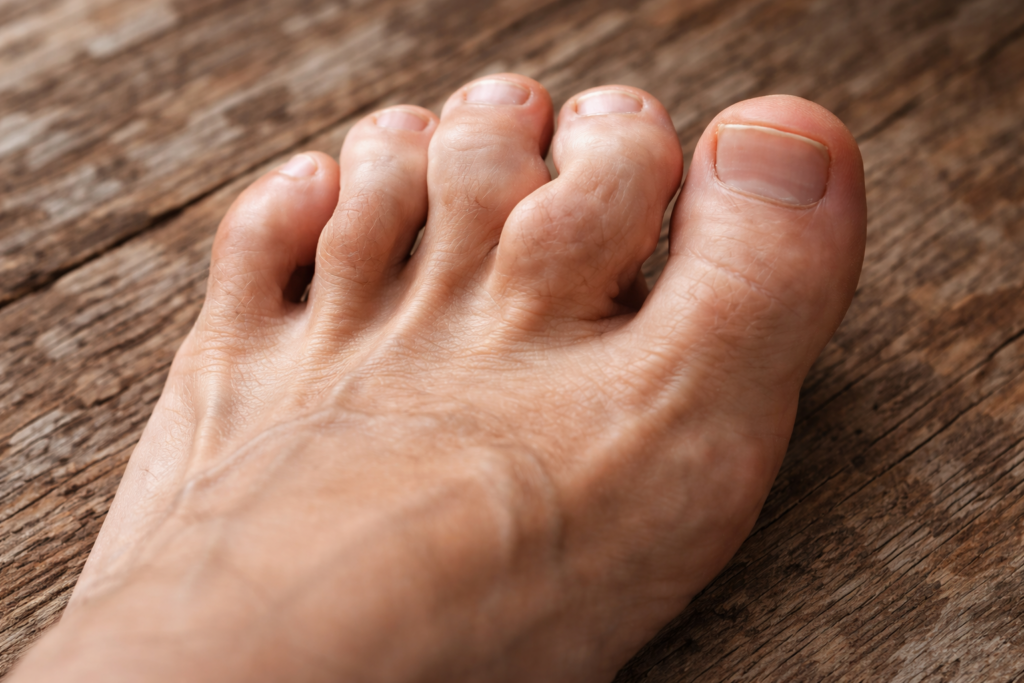 O que é doença gota? Entenda a causa da dor articular intensa