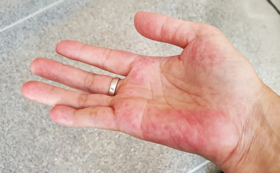 Tratamentos para lúpus eritematoso sistêmico: Guia completo para o controle da doença